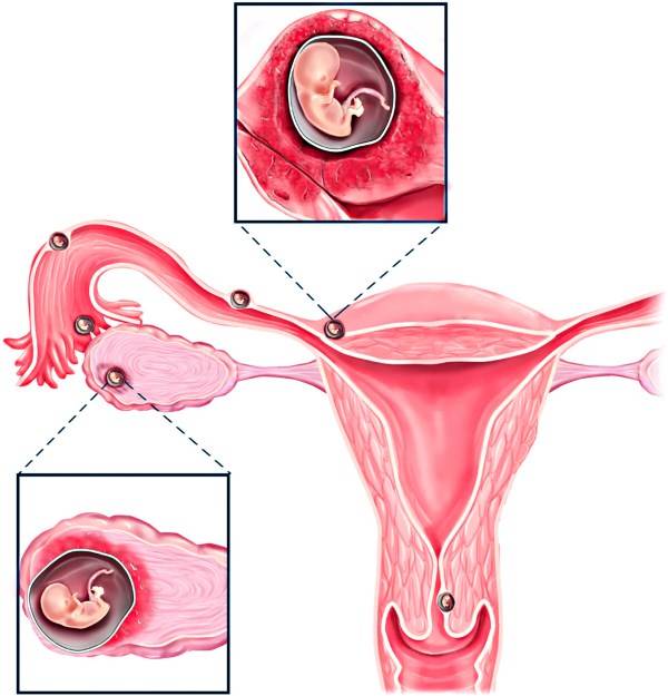 Беременность внематочная