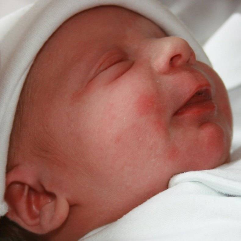 Гемолитическая болезнь новорожденных - "наша радость"