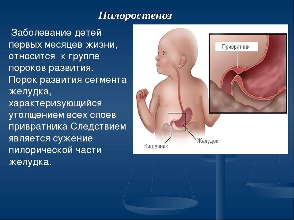 Синдром стеноза. Врожденный гипертрофический пилоростеноз. Пилоростеноз привратника патогенез. Врожденный гипертрофический пилоростеноз патогенез. Субкомпенсированный пилоростеноз.