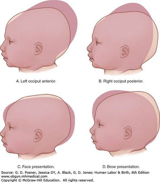Пороки развития челюстно-лицевой области эмбриона на узи