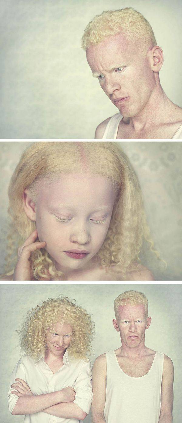 Альбинизм: что это, почему возникает и как живут альбиносы?