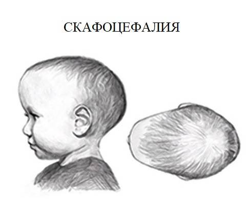 Увеличение окружности головы (макроцефалия) у ребенка