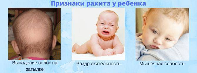 Рахит у детей: как определить и чем лечить — объясняют врачи - parents.ru | parents