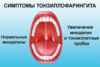 Спрей для горла детям: детский спрей от боли в горле: как применять при ангине