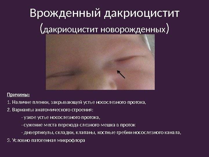 Сколько дней ребенок может болеть блефаритом? - энциклопедия ochkov.net