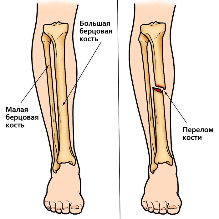 Оказание первой помощи при травме коленного сустава и голени