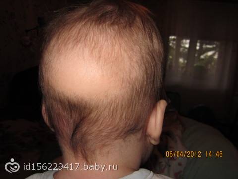 Причины выпадения волос у новорожденных и грудничков