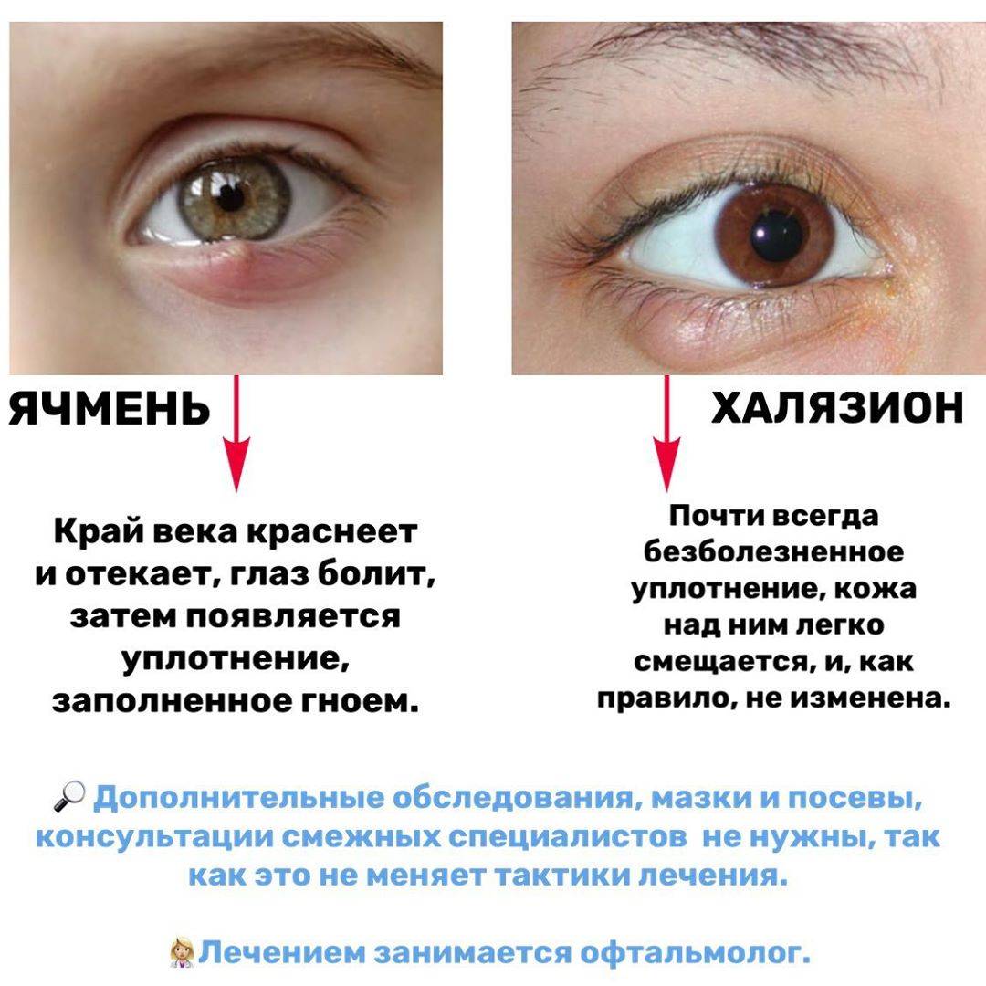 Воспалительные заболевания глаз