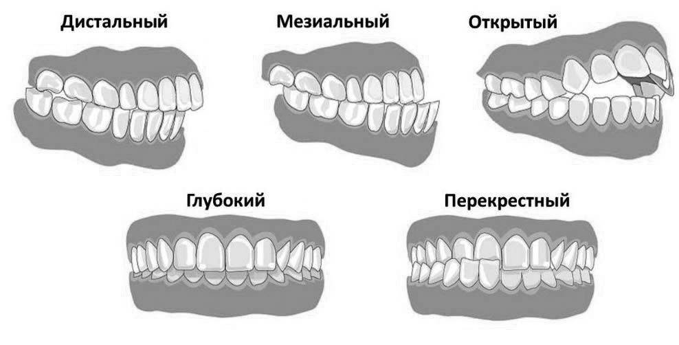 Перекус зубы. Правильный прикус вид сбоку. Глубокий прикус у человека схема.