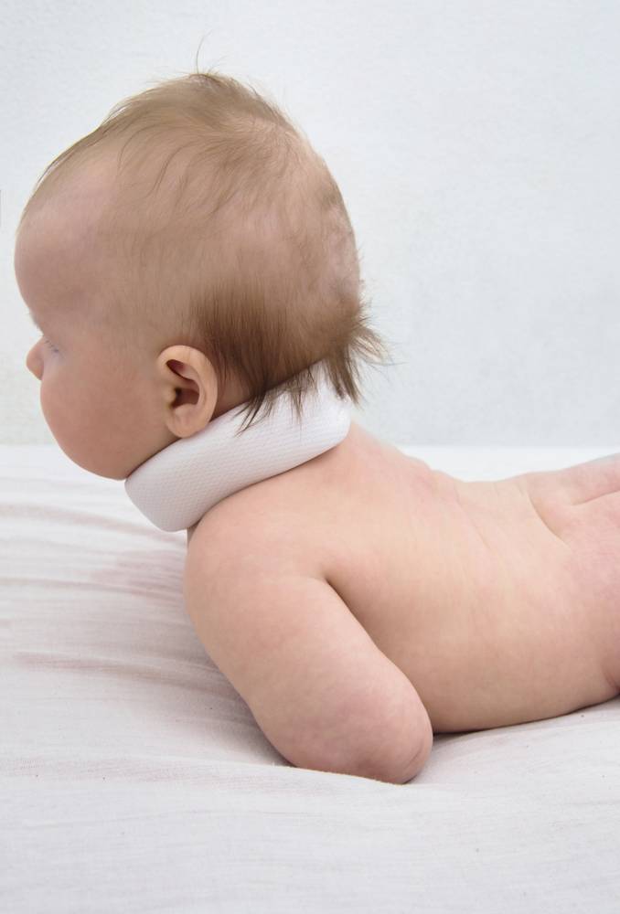 Кривошея у новорожденных: признаки появления, методы лечения