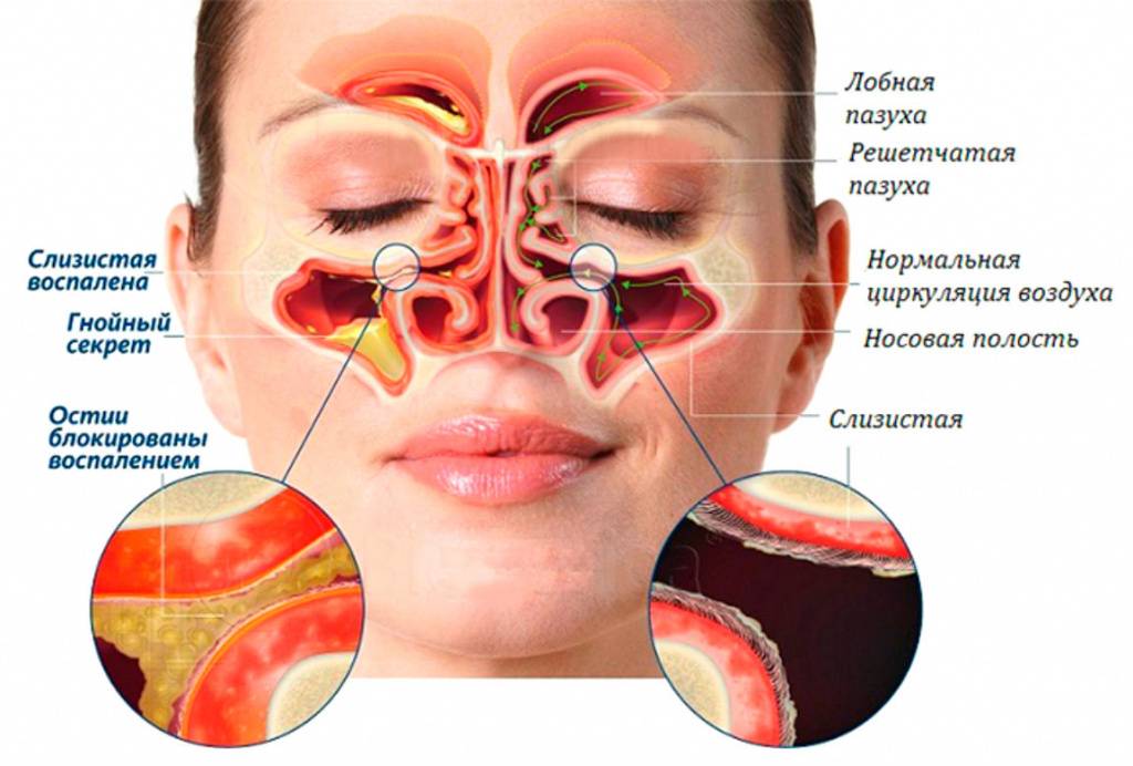 Воспаление синусов. Носовые и гайморовы пазухи. Острый фронтальный синусит симптомы.