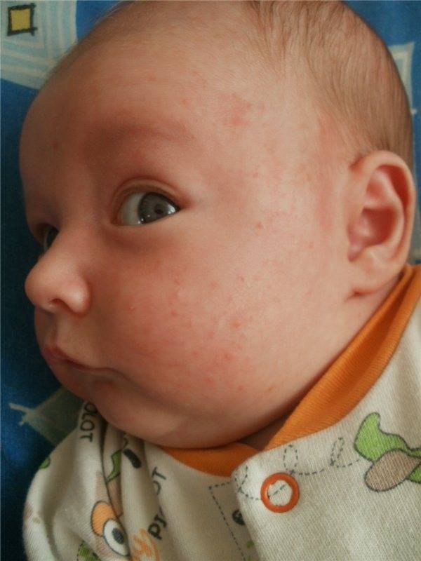 Аллергия на щеках у детей – причины, симптомы и лечение аллергии на щеках у ребенка