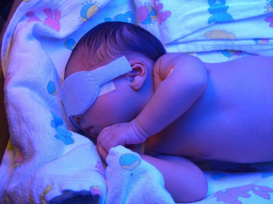 Норма билирубина у новорожденных