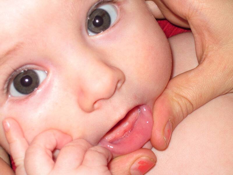 Температура у ребенка при прорезывании зубов: что делать?