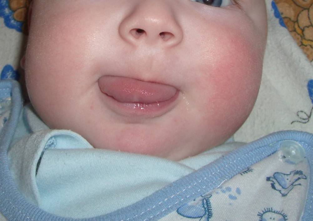 Мозоль на губе у новорожденного при грудном вскармливании