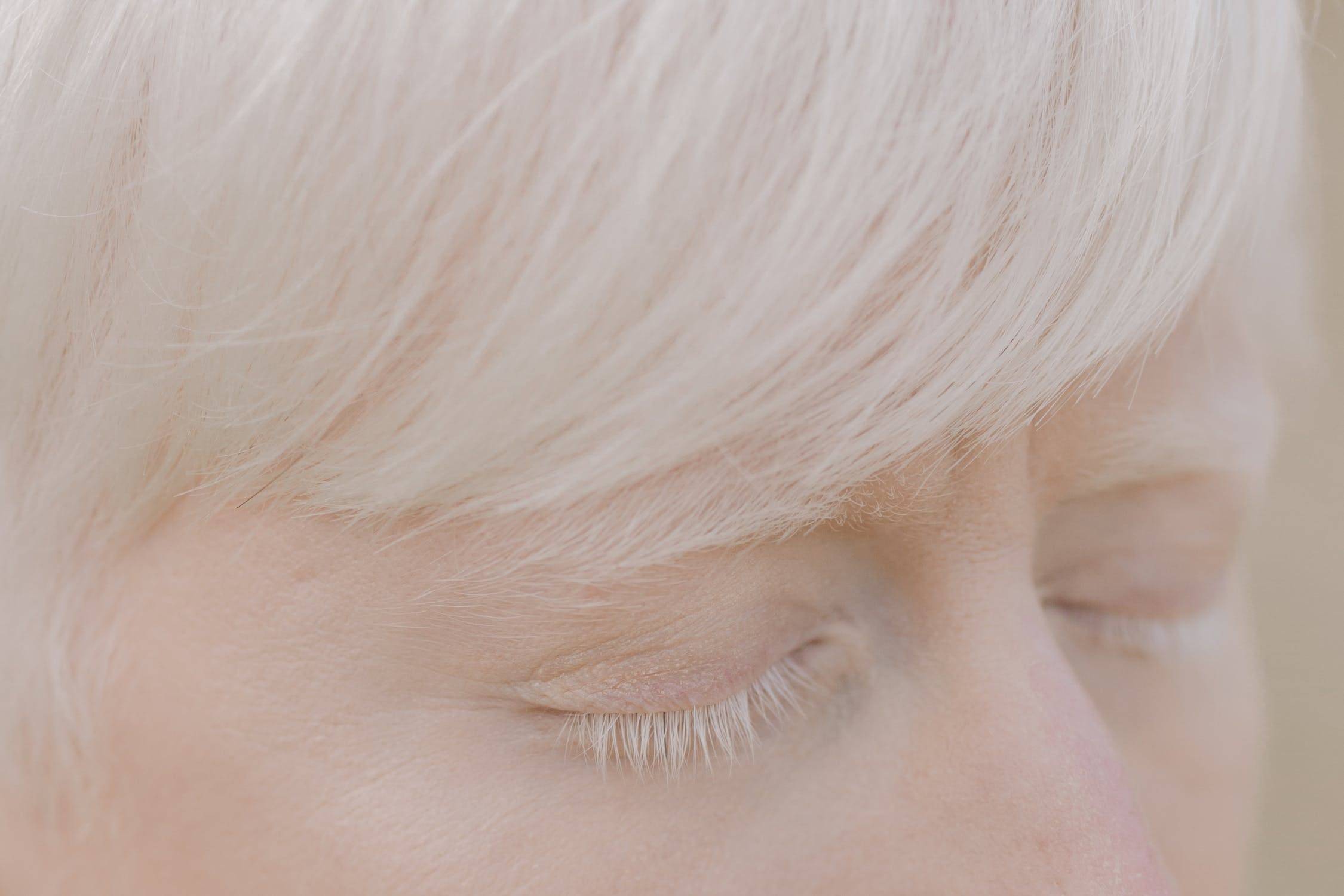 Что такое альбинизм и как он влияет на качество жизни