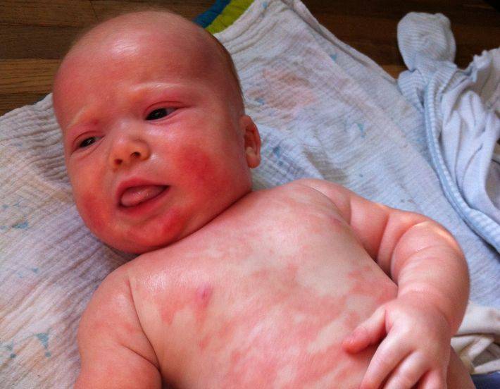Пищевая аллергия у детей до года