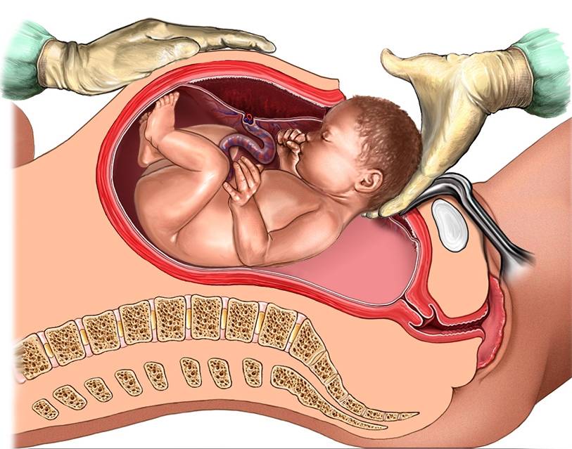Низкая плацента при беременности: чем опасна и как рожать?