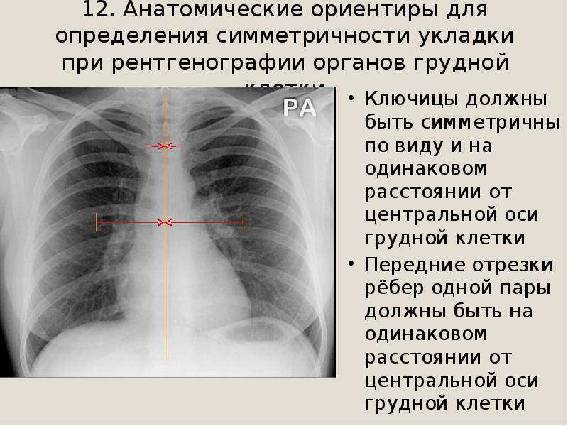 Рентген грудной клетки: что показывает, как проводится. показания к рентгену органов грудной клетки
