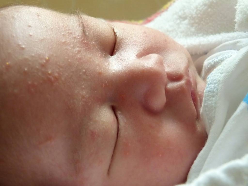 Опрелости на шее у новорожденных: чем лечить, чем мазать | мокнет шея у грудничка