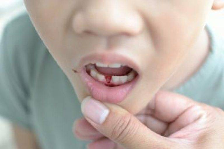 Статья о стоматологии: ребенок сломал, вывихнул, ударил или расколол зуб. что делать?