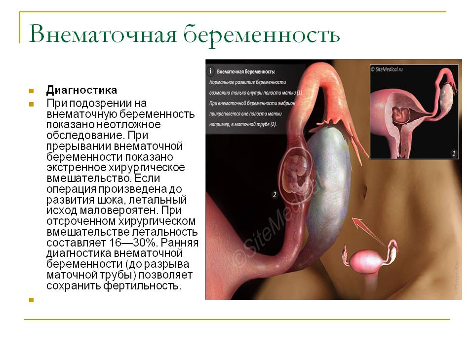 Внематочная беременность — признаки и лечение опасной патологии * клиника диана в санкт-петербурге
