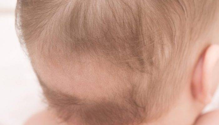 Что делать, если у новорожденного выпадают волосы