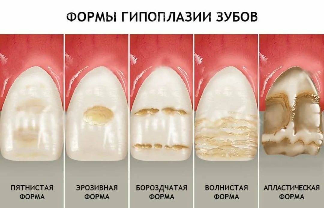 Чернеют молочные зубы — почему так происходит?