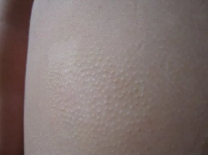 Шершавое пятно на коже у грудничка: причины появления и лечение
