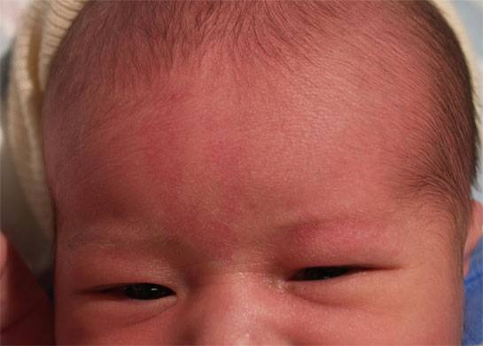 Пищевая аллергия на щеках у новорожденных: чем лечить крапивницу | nutrilak