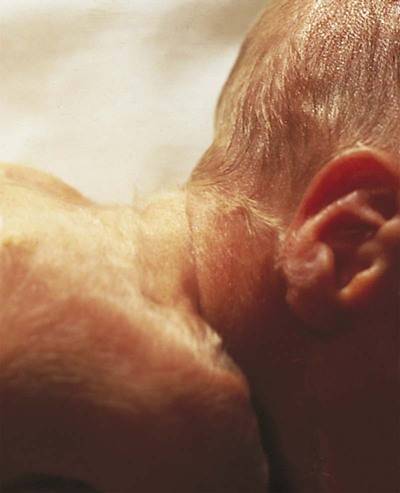 Щетинка у новорожденных: как ее определить и вывести на спине у ребенка