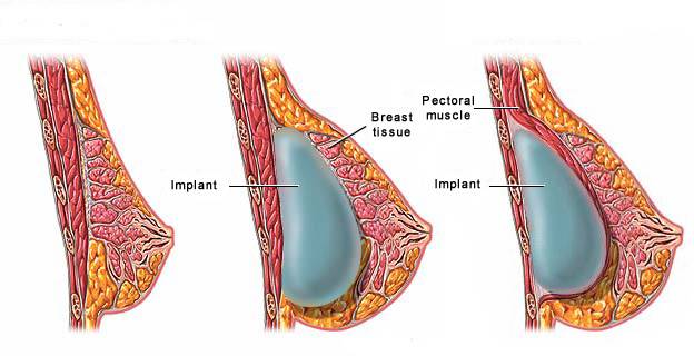 Кормление грудью с имплантами
