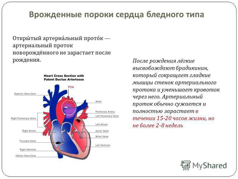 Врожденные пороки сердца (впс) у детей - симптомы болезни, профилактика и лечение врожденных пороков сердца (впс) у детей, причины заболевания и его диагностика на eurolab