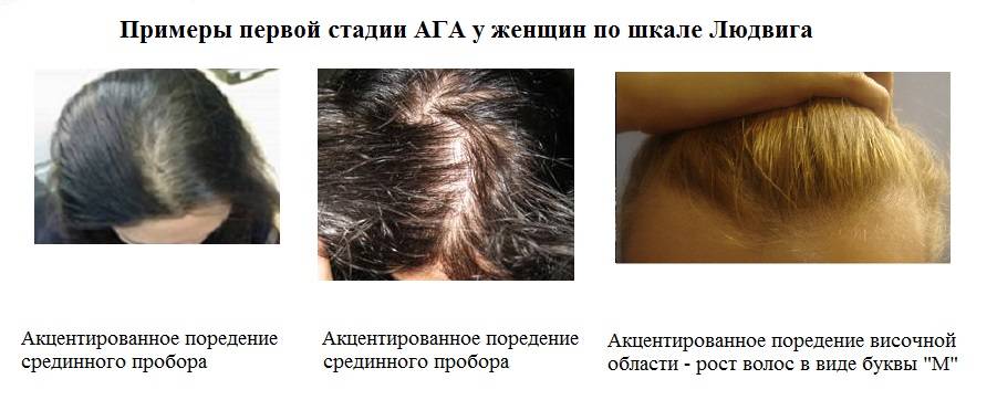Применение фолиевой кислоты при выпадении волос у женщин