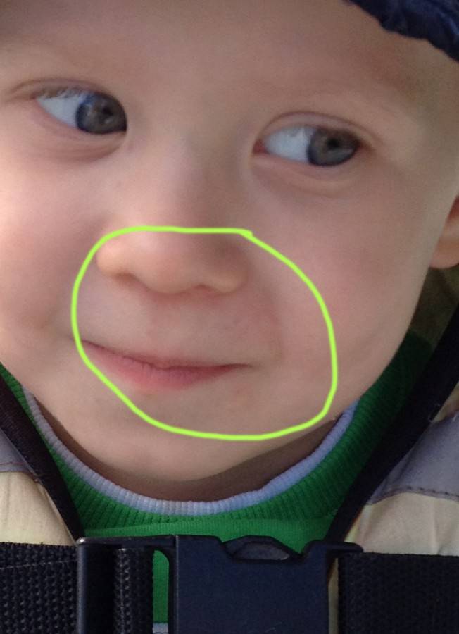 Цианоз носогубного треугольника, губ и носа у грудного ребенка