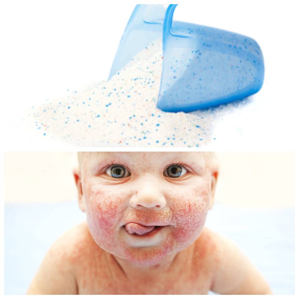 Аллергия на коже у ребенка: причины, лечение, эффективные кремы