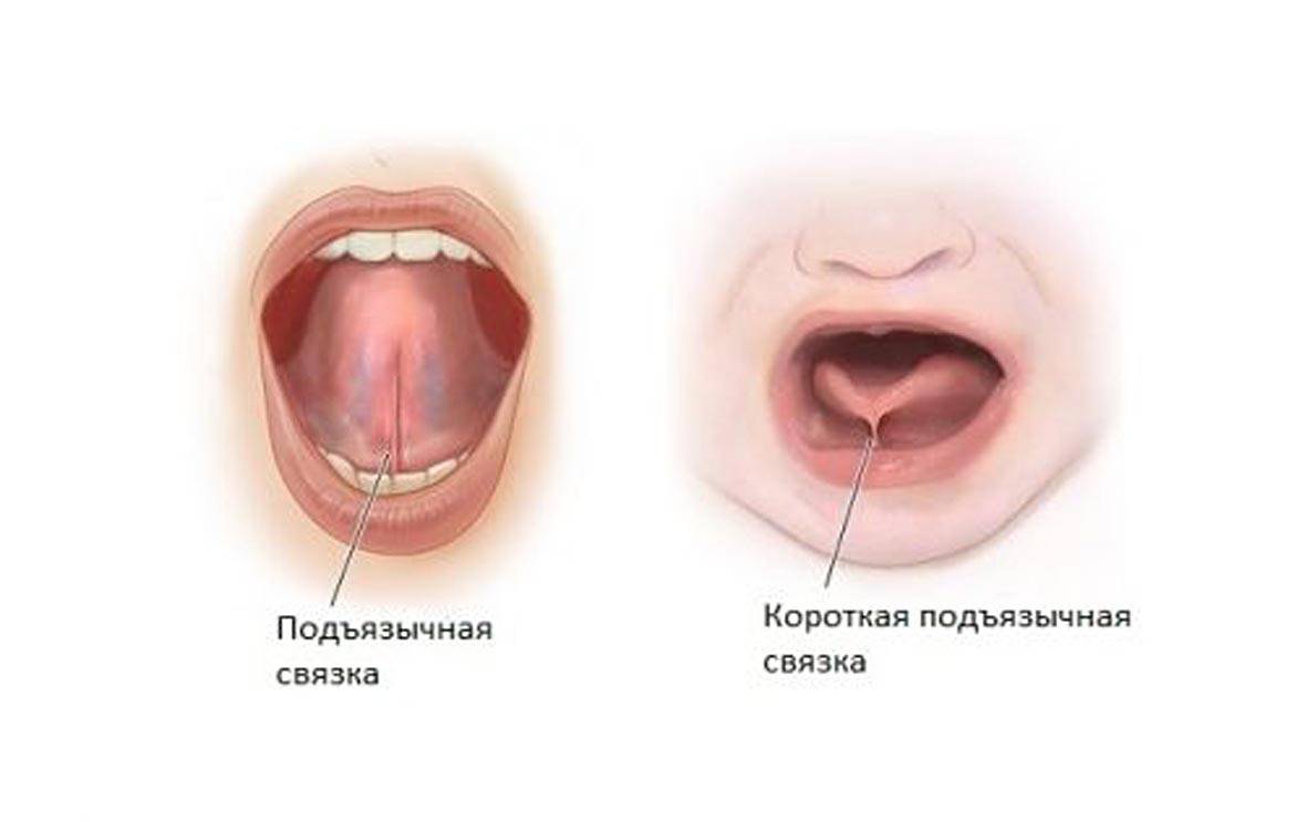 Коррекция уздечки – стоматология президент
