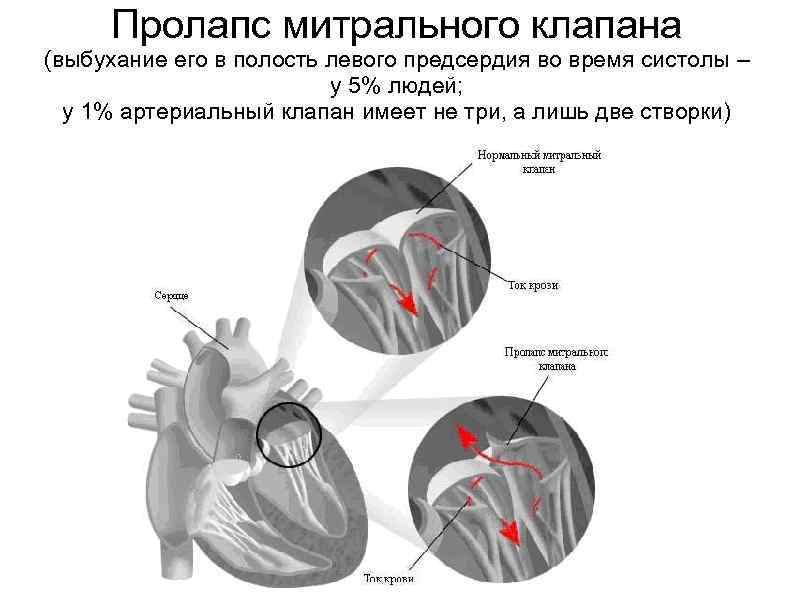 Пролапсы клапанов сердца. диагностика и лечение