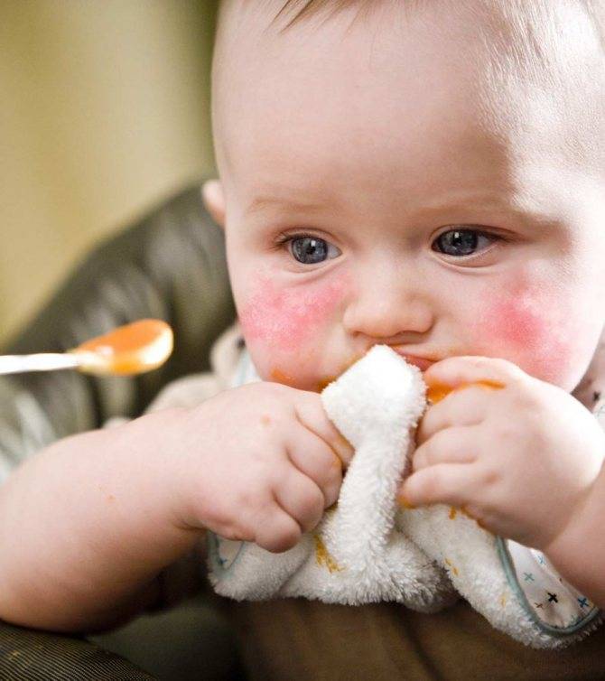 Чем кормить ребенка при диатезе (атопическом дерматите)