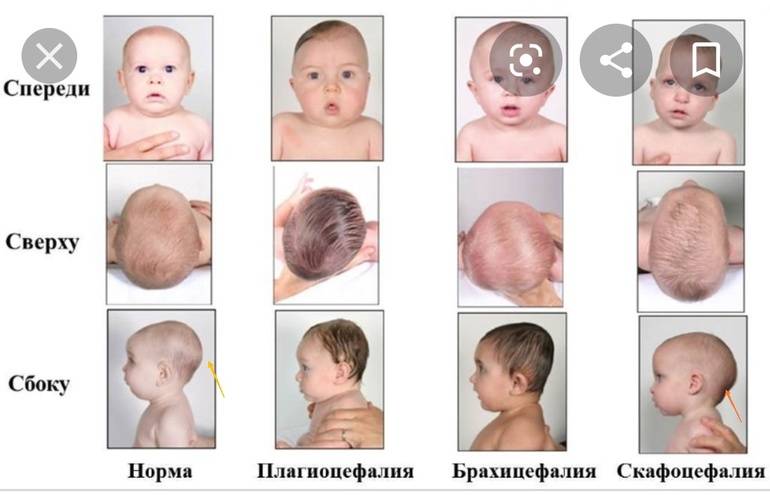 Последствия неправильного прикуса зубов: к чему приводит, что с ним делать, чем грозит и на что влияет плохое смыкание у взрослых