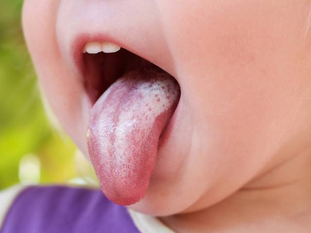 Пятна и налет на языке у ребенка: причины, лечение