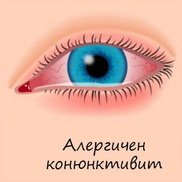 Вирусный конъюнктивит глаз: лечение, причины и симптомы, признаки заболевания