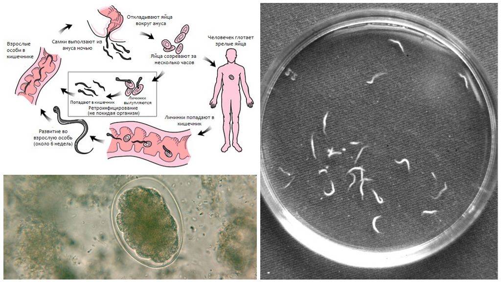 Лечение энтеробиоза. Энтеробиоз острицы у детей. Заражение энтеробиозом острицы. Инвазионная стадия острицы. Самозаражение энтеробиозом.