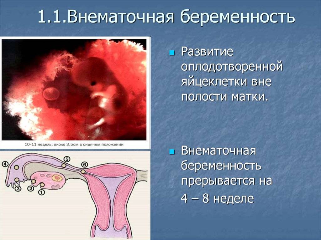Внематочная беременность. причины, симптомы и лечение!