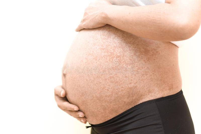 Какие кожные заболевания возникают во время беременности и чем их лечить * клиника диана в санкт-петербурге