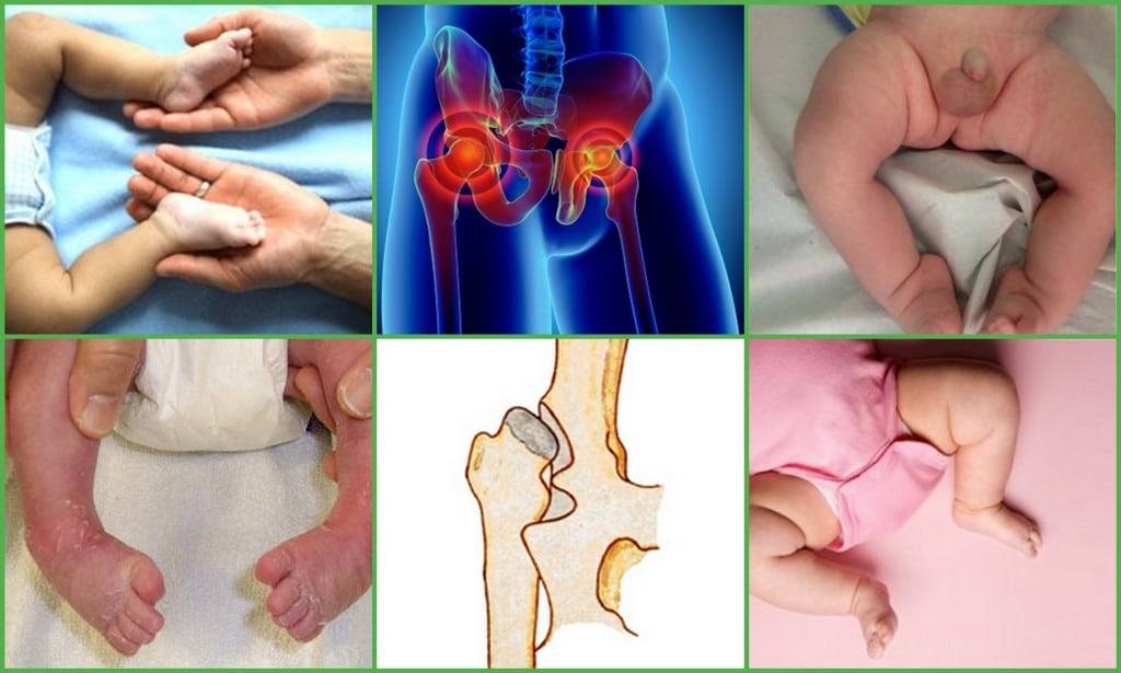 Дисплазия тазобедренного сустава у взрослых и детей: причины, диагностика, лечение, последствия