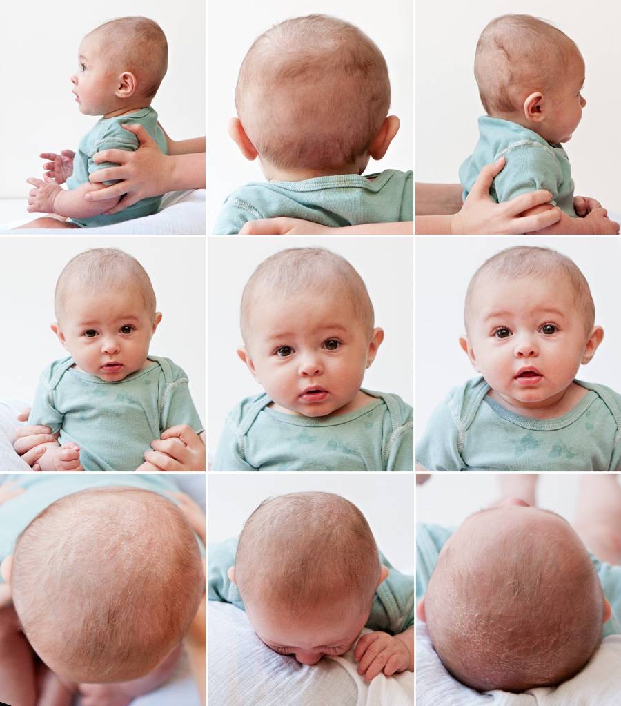 Кривошея у новорожденных фото как понять