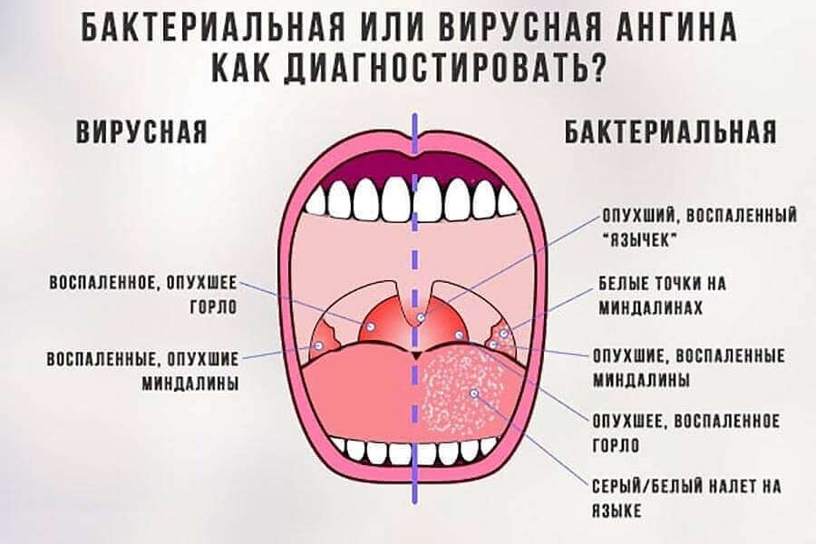 Ангина симптомы отличие от орви у взрослого без температуры фото