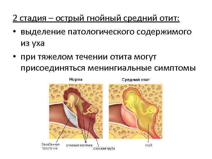 Причины воспаления среднего уха. Катаральный и Гнойный отит.