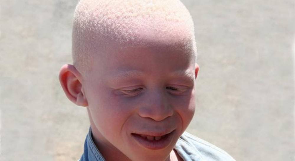 Альбинизм у человека - причины возникновения и как наследуется
